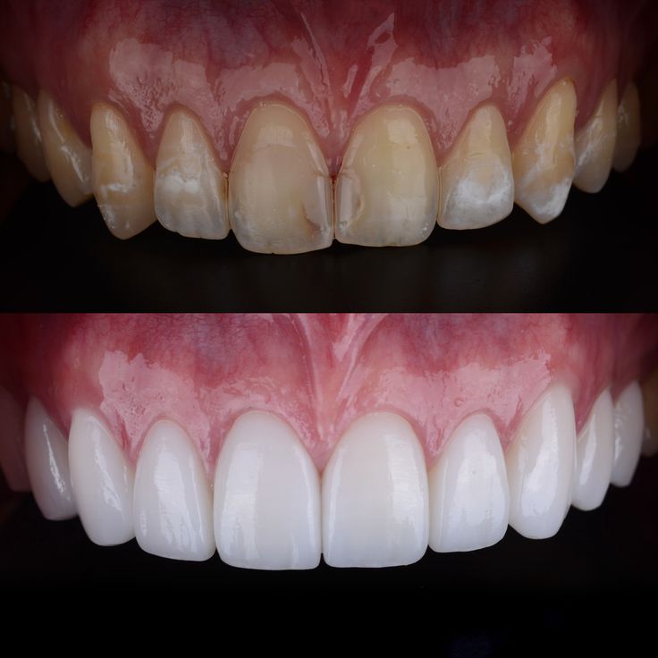 Estrutura de facetas de resina em detalhe